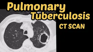 Pulmonary Tuberculosis | CT Scan Chest | Radiology