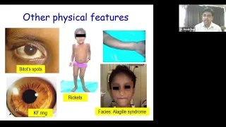 Approach to Chronic Liver Disease in Children by Dr Moinak Sen Sarma