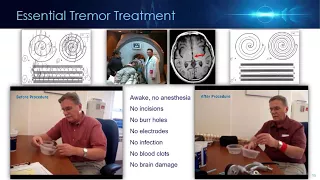 ISMRM MR Academy - MR-Guided Focused Ultrasound in the Brain - Description, Overview & Method