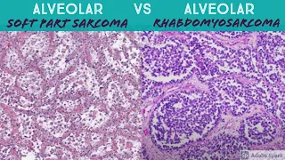 Alveolar Soft Part Sarcoma vs Alveolar Rhabdomyosarcoma