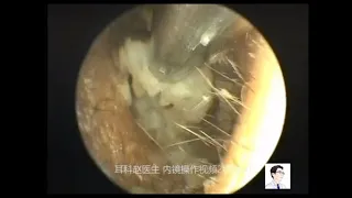 Second cases of external ear canal cholesteatoma, common earwax embolism and otitis media 11 minutes