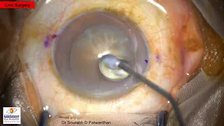 Hard cataract  Live Surgery Dr Sourabh D Patwardhan