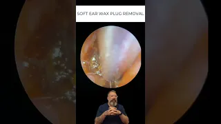 SOFT EAR WAX PLUG REMOVAL