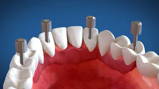 Video Animazione 3D Implantologia dentale a carico immediato (Sistema Modulabile)