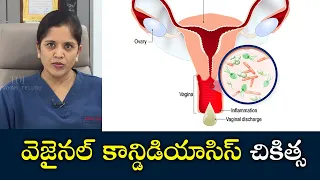 Treatment for Vaginal Candidiasis | Samayam Telugu