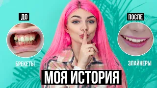 Моя История Выпрямления Зубов 😬  Удаление, Брекеты, Элайнеры, Импланты | До и После + Ответы