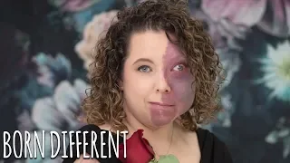 I Wouldn't Leave The House - But I Accept My Birthmark Now | BORN DIFFERENT
