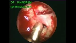 Optic Nerve Decompression Left [Ear, Nose and Throat]