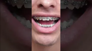 Teeth Feel Loose During Braces - But Is This Normal? 😬