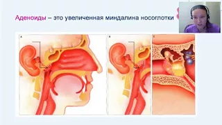 Вебинар лор-врач об аденоидах