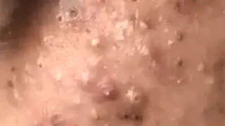 Huge Acne Pimples Blackheads Popping Up Satisfying with Oddly Calm Music