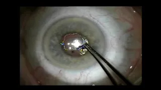 Fuchs Dystrophy Corrected without Corneal Transplant: Gulani DSERV Technique