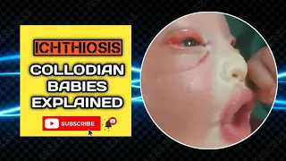 Ichthyosis: Collodian's Tale | Complete Guide