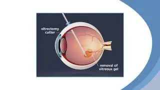 Why Face Down After a Vitrectomy?