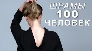 100 ЧЕЛОВЕК ПОКАЗЫВАЮТ СВОИ ШРАМЫ