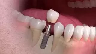 Straumann - Implant-borne single-tooth treatment