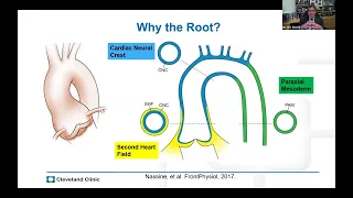 Dr. Eric Roselli on Aortic Root Surgery in Connective Tissue Conditions