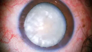 Phaco Chop for the Beautiful Pearl White Cataract Surgery