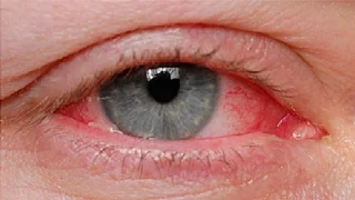 The Basics: Pinkeye Causes and Treatments