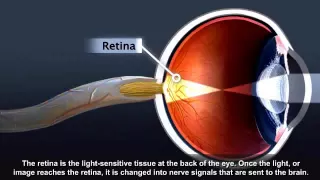 NEI Animation Cataract