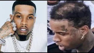 Tory Lanez REVEALS He Has ALOPECIA After Getting CLOWNED For His BALD SPOT