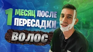 ПЕРЕСАДКА БОРОДЫ. ОТЧЁТ НА 30-Й ДЕНЬ. НАЧАЛИ ВЫПАДАТЬ ПЕРЕСАЖЕННЫЕ ГРАФТЫ!!!