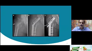 OrthoTV Original Fixation Failures in IT Fractures   Dr Satish Mutha