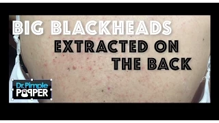Re-introduction to Big Blackheads on the Back