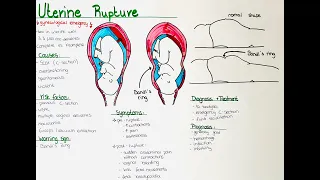 Uterine Rupture - types, causes, risk factors, symptoms, diagnosis, treatment, prognosis+prophylaxis