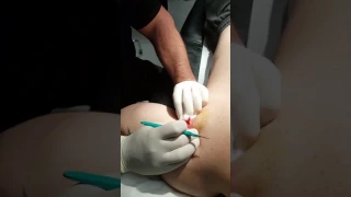 Infected sebaceous cyst