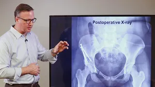 Ganz Osteotomy Surgery  - What to Expect