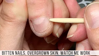 Manicuring Bitten Nails with Overgrown Skin. New Client. | Watch Me Work