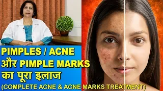 Pimples/Acne और Pimple Marks का पूरा इलाज || Complete Treatment of Acne & Acne Marks