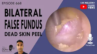 668 - Bilateral False Fundus Dead Skin Peel