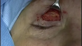 Upper eyelid crease anterior orbitotomy