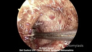 Otomyiasis | Maggots in Ear | Endoscopic Maggots Removal from ear