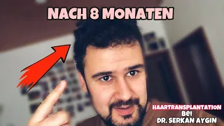 8 Monate nach der Haartransplantation in der Türkei - Dr.Serkan Aygin Clinic