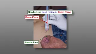 Fine Needle Aspiration Biopsy (FNA) Techniques - Ultrasound Guided FNA The Parallel Approach