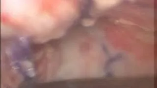 davidov vaginoplasty 10 days post op