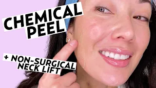 Getting a Vi Peel Chemical Peel & Non-Surgical Neck Lift! | Skincare with Susan Yara