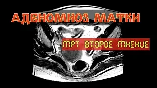 Обнаружен диффузный АДЕНОМИОЗ МАТКИ на МРТ РАСШИФРОВКЕ малого таза