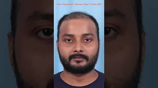 Hair Transplant Results Day 1 to Day 180 #shorts #hairtransplant 7426859490 WhatsApp