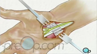 Carpal Tunnel Syndrome Surgery - PreOp Patient Education