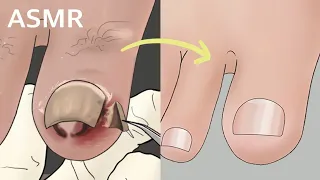 Satisfying Ingrown toenail removal treatment animation