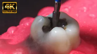 4K  AMAZING alternative to rebuilding decayed teeth: inlay