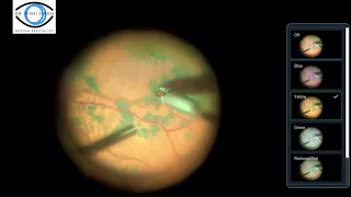 Using Color Channels To Enhance Vitreoretinal Surgery   HD 1080p