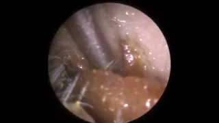 827 - Extra Large Ear Wax Removal