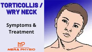 Torticollis (Wry neck) | Causes,Symptoms,Diagnosis,Treatment,Exercises | In Hindi | Mera Physio