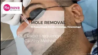 Mole Removal Treatment Using RF(Radiofrequency) Cautery Method in Jaipur - Dr Punet Goyal