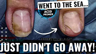 ⚡Manicure tutorial: ONYCHOLYSIS of the NAILS😱Acid primer. Nail exfoliation😐 Onycholysis cleanup